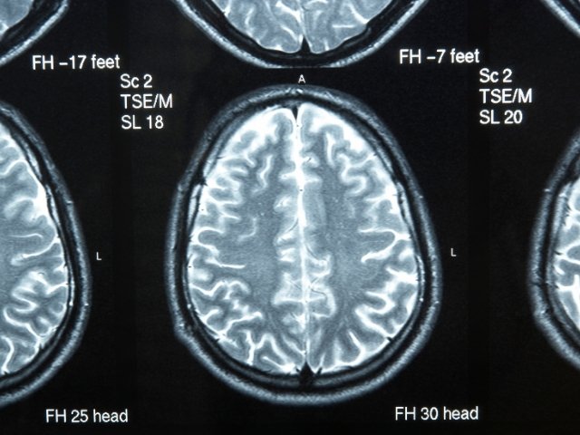 Cerebro joven 1